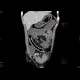 Crohn's disease, aboral ileum, enterography: CT - Computed tomography